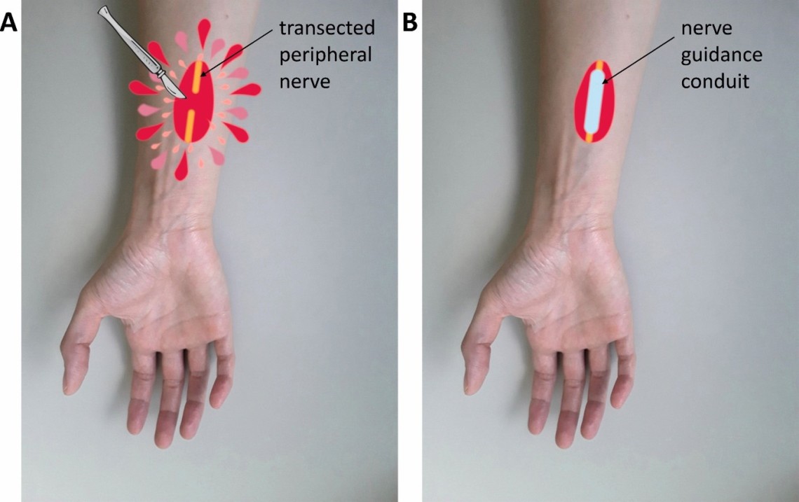 (A) Uszkodzenie nerwu obwodowego przez przerwanie jego ciągłości anatomicznej powodujące utratę funkcji i (B) wszczepienie implantu nerwowego w celu połączenia kikutów nerwów.