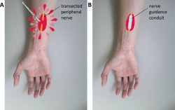 (A) Uszkodzenie nerwu obwodowego przez przerwanie jego ciągłości anatomicznej powodujące utratę funkcji i (B) wszczepienie implantu nerwowego w celu połączenia kikutów nerwów.